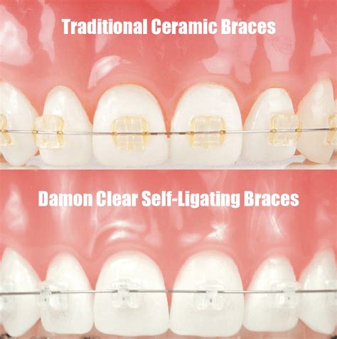 damon clear vs ceramic braces